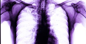 Tuberculoza în vremea COVID-19: Măsurile de restricţie a circulaţiei au afectat accesul la diagnostic al celor cu simptome de tuberculoză