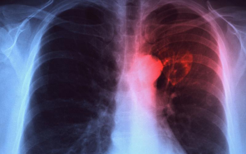 Giurgiu: Peste 1.000 de persoane vor beneficia de servicii medicale gratuite pentru depistarea tuberculozei