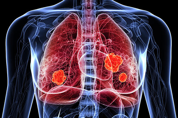 Ziua Mondială de luptă împotriva Cancerului Pulmonar, marcată anual pe 1 august