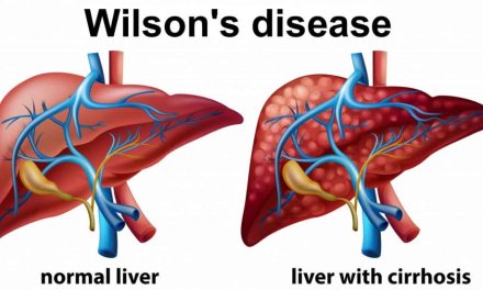 Ce este boala Wilson, descoperită la fetița de 5 ani cu suspiciune de hepatită atipică